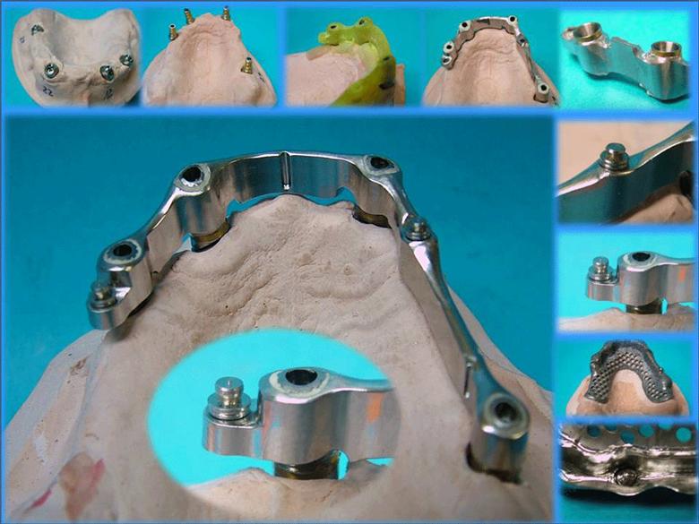 Telescopic attachment for implantbar dentures Milling machines